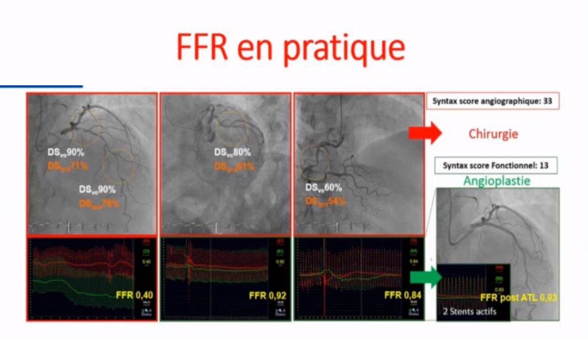 Trois angiographies coronaires avec leurs courbes de réserve de débit fractionnaire — 0,40, 0,92 et 0,84 — et deux scores SYNTAX : 33 en anatomique menant à la chirurgie, 13 en fonctionnel menant à l'angioplastie.