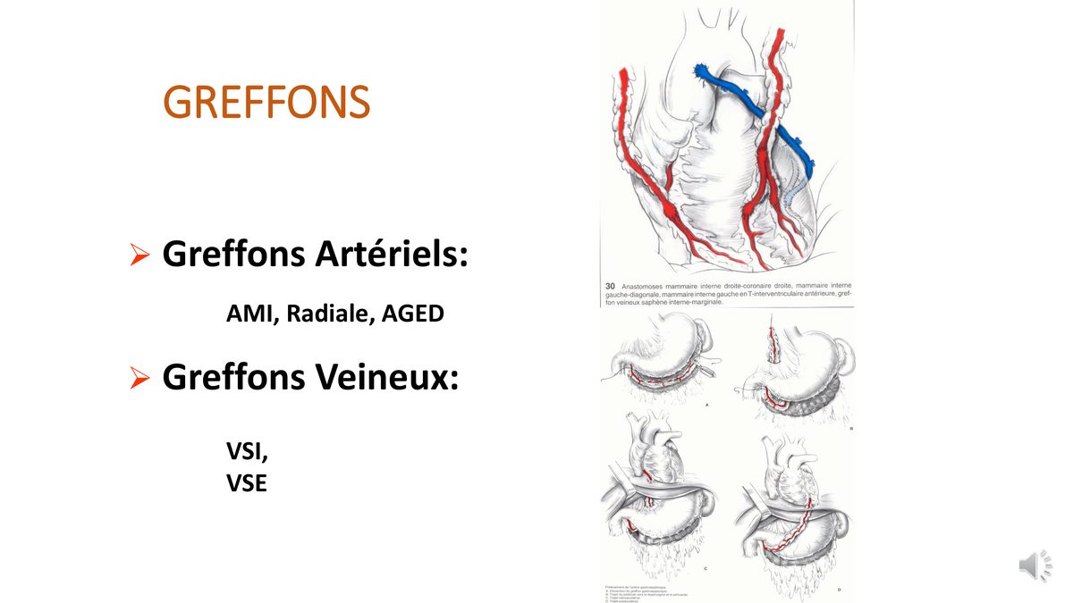 Schéma des greffons artériels et veineux et de plusieurs montages de pontage aorto-coronaire.