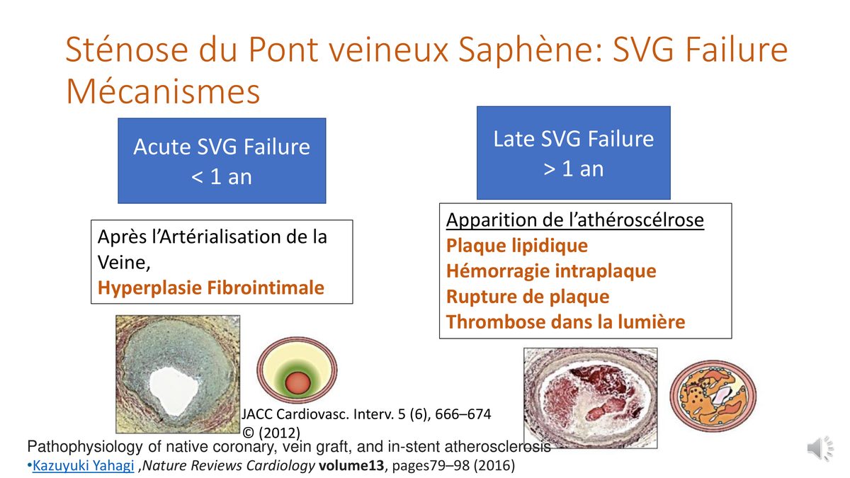 Deux colonnes opposant la défaillance précoce par hyperplasie fibro-intimale à la défaillance tardive par athérosclérose, avec leurs coupes histologiques.