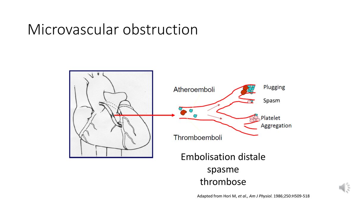 Schéma montrant l'embolisation d'athéro-embols et de thrombo-embols vers le lit d'aval, avec obstruction, spasme et agrégation plaquettaire.