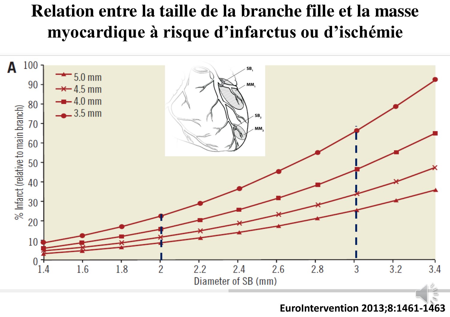 Graphique portant en abscisse le diamètre de la branche fille de 1,4 à 3,4 millimètres et en ordonnée le pourcentage d'infarctus relatif à la branche mère : quatre courbes croissantes correspondant à des branches mères de 3,5 à 5 millimètres, encart anatomique montrant les territoires de deux collatérales.