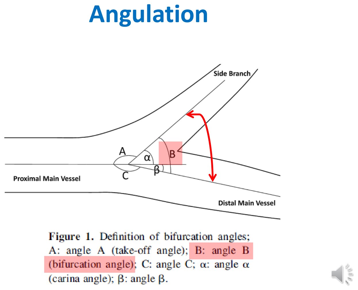 Schéma en coupe longitudinale d'une bifurcation où sont tracés et étiquetés les angles A, B et C ainsi que les angles alpha et bêta, avec la branche fille en haut, le vaisseau principal proximal à gauche et le vaisseau principal distal à droite.