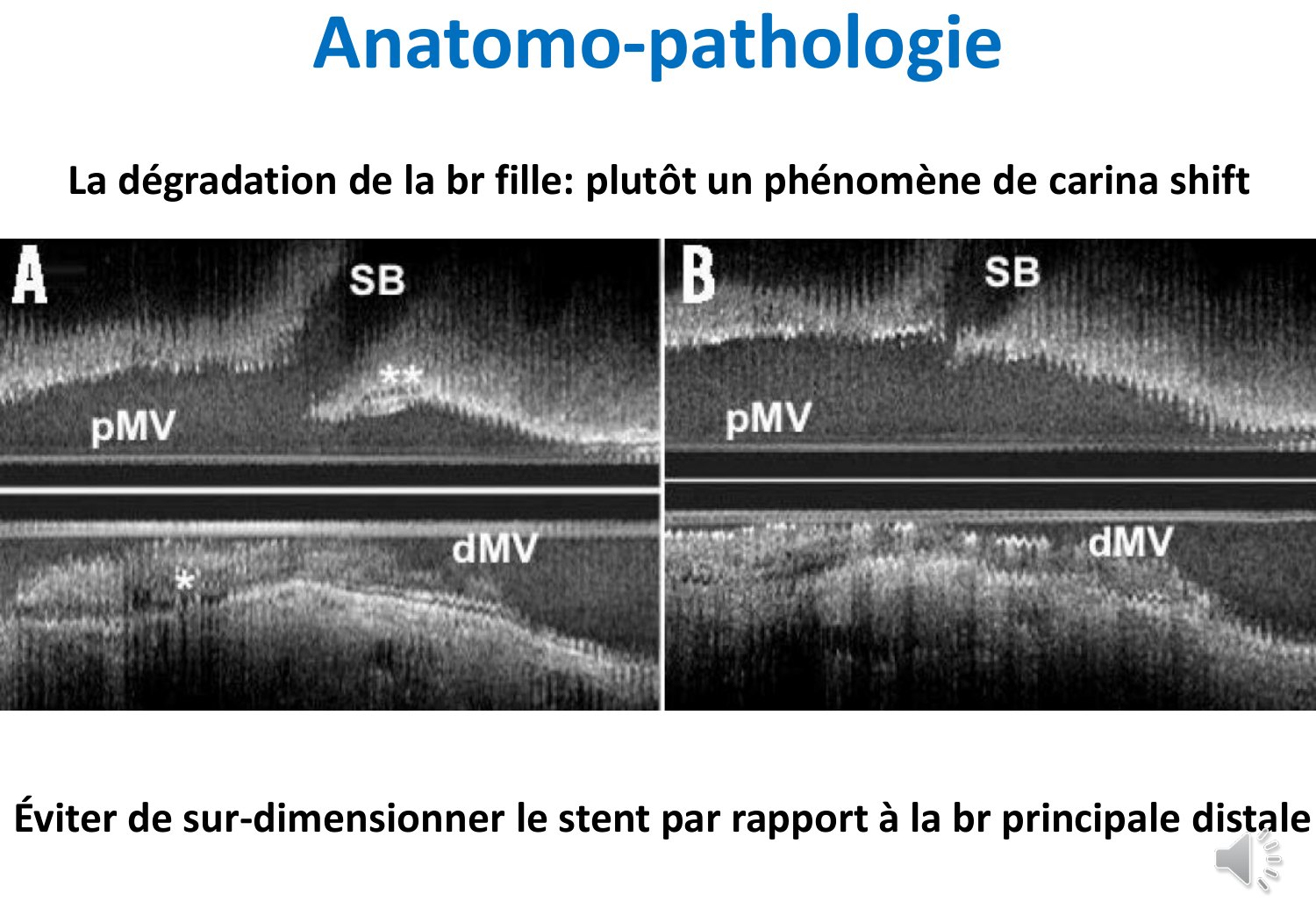 Deux reconstructions longitudinales en imagerie endocoronaire côte à côte, chacune montrant le segment proximal du vaisseau principal, l'ostium de la branche fille et le segment distal : à gauche l'état avant implantation, la carène repérée par des astérisques, à droite l'état après implantation où l'ostium de la branche fille apparaît plus étroit.