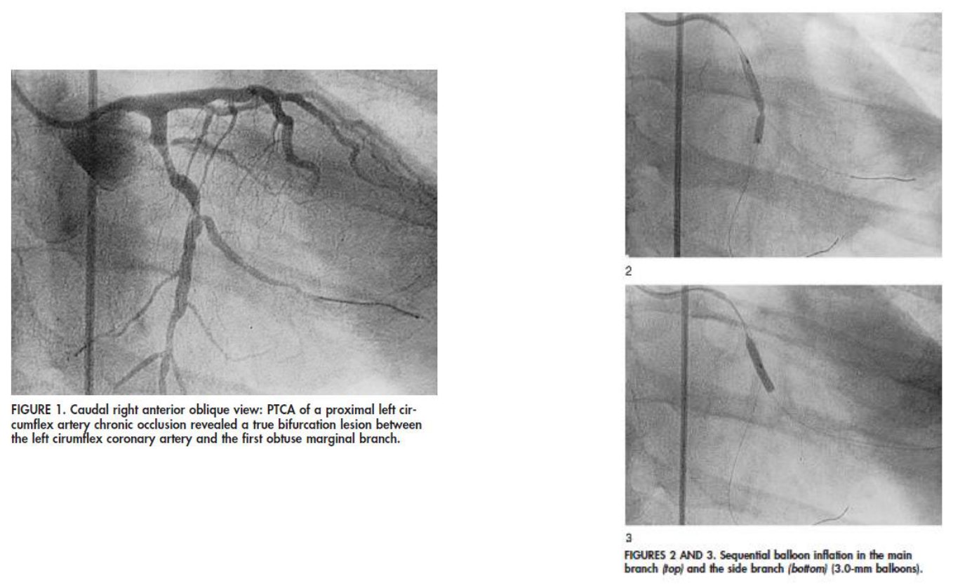 Trois clichés angiographiques légendés : une incidence oblique antérieure droite caudale montrant une vraie bifurcation entre l'artère circonflexe et la première marginale obtuse, puis deux clichés d'inflation successive d'un ballon dans la branche principale et dans la branche collatérale.
