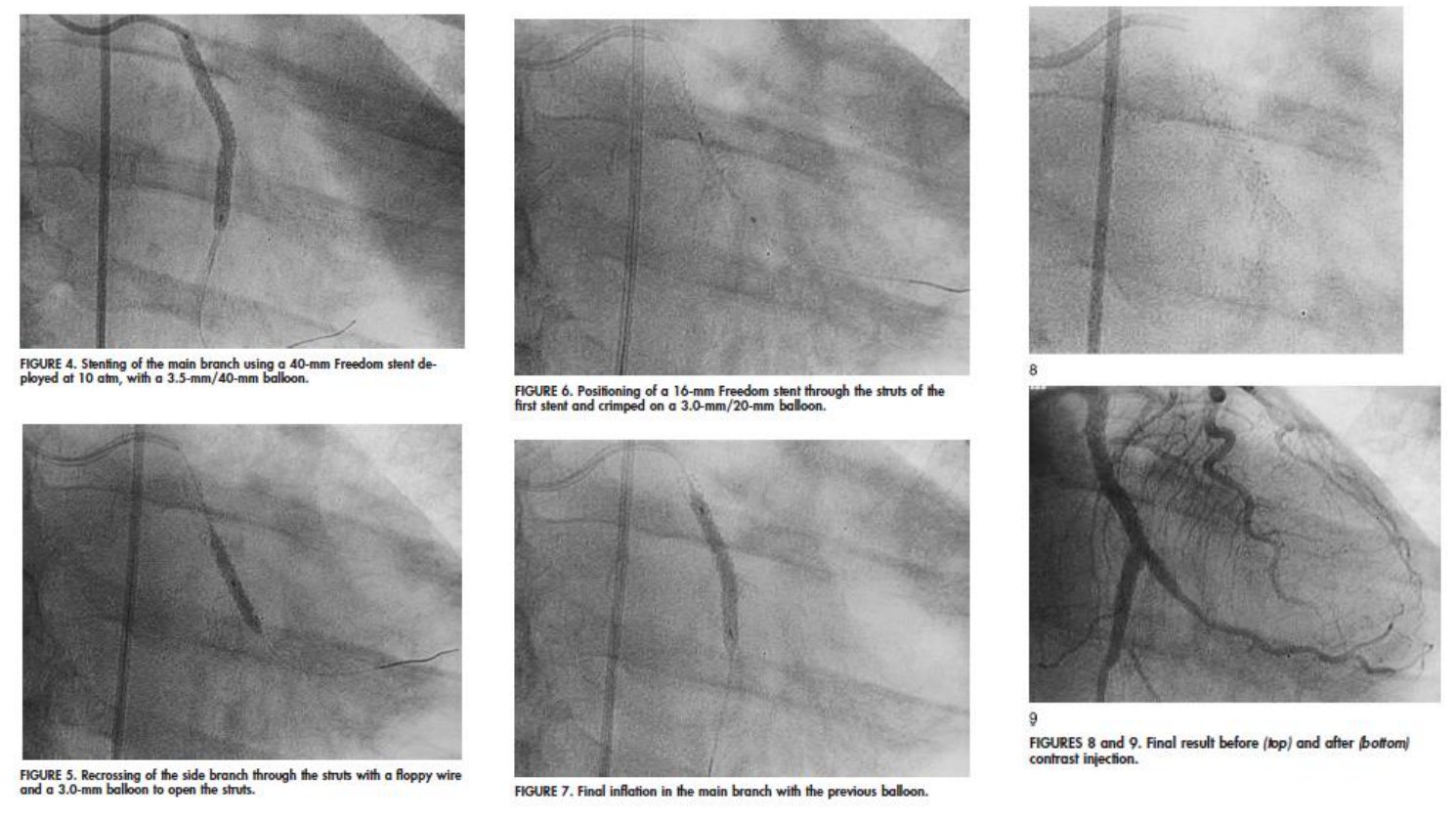 Série de six clichés angiographiques légendés montrant, dans l'ordre, l'implantation de l'endoprothèse de la branche principale, le re-franchissement de la collatérale par un guide souple, le positionnement de la seconde endoprothèse à travers les mailles de la première, l'inflation finale et le résultat après injection de contraste.