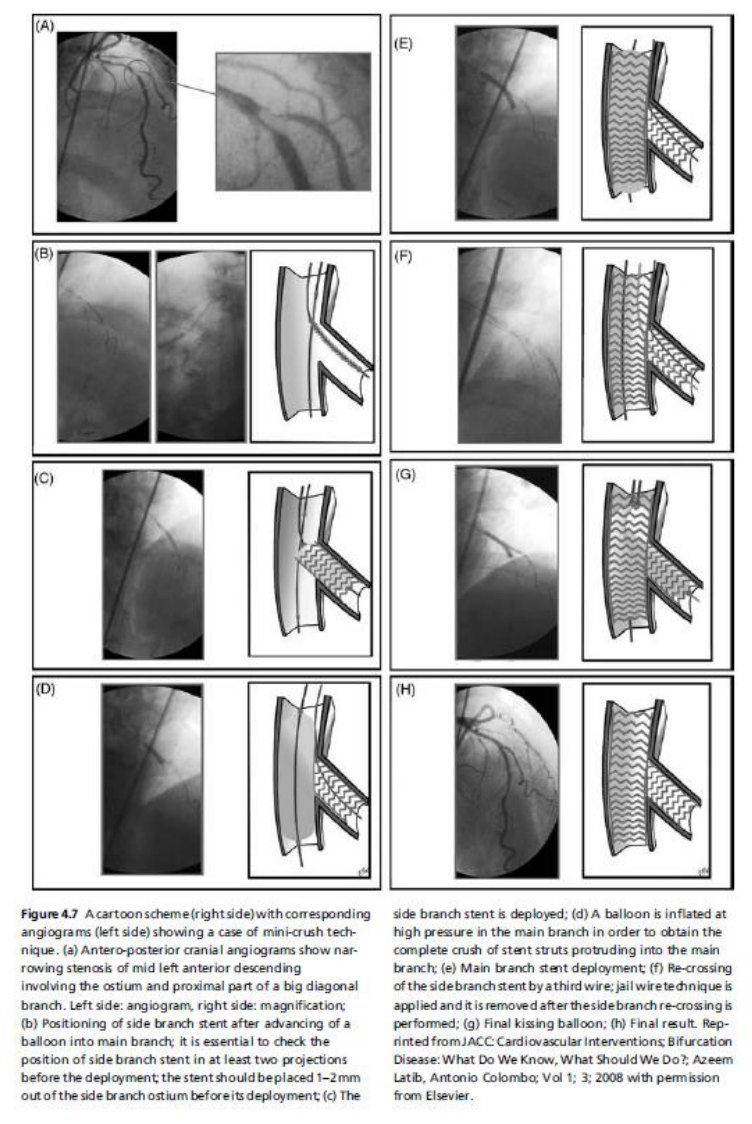 Planche en huit vignettes appariant chacune un cliché angiographique et un schéma en coupe : positionnement de l'endoprothèse de la branche fille avec un ballon déjà avancé dans la branche principale, déploiement, écrasement à haute pression, implantation de l'endoprothèse principale, re-franchissement par un troisième guide, kissing final et résultat.