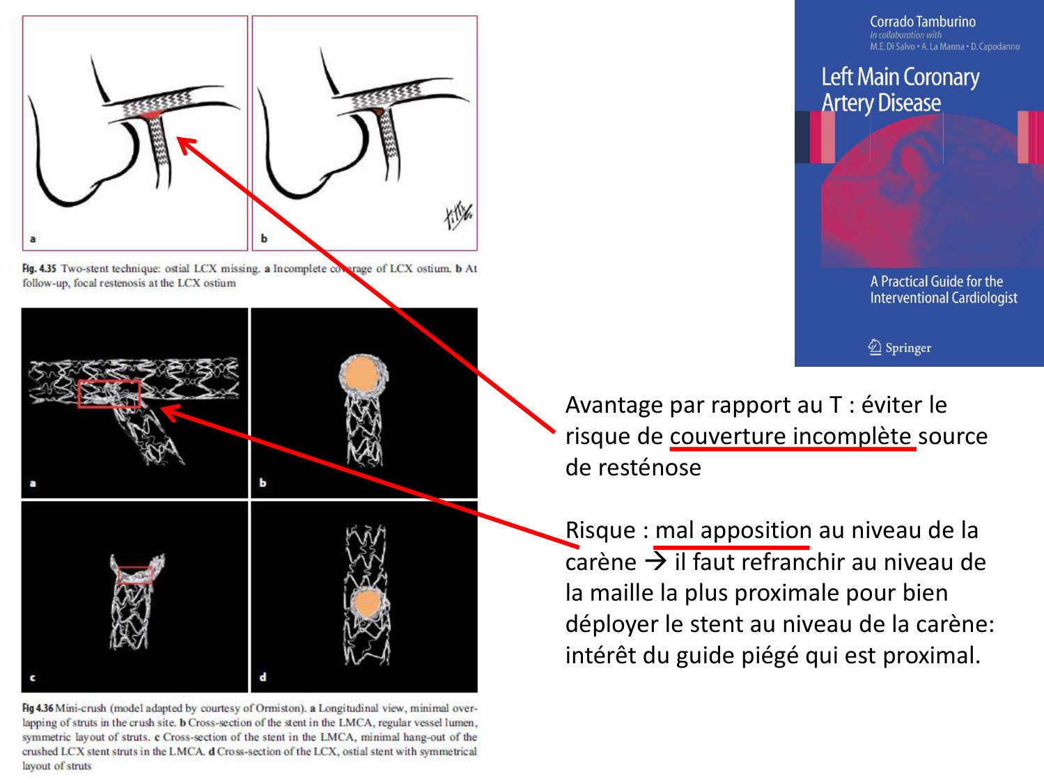 Deux planches superposées : la première montre en schéma un ostium de branche fille laissé découvert puis, au contrôle, une resténose focale à cet endroit ; la seconde montre en vue longitudinale et en quatre coupes transversales le chevauchement minimal des mailles obtenu après écrasement, avec une lumière régulière dans le vaisseau principal.