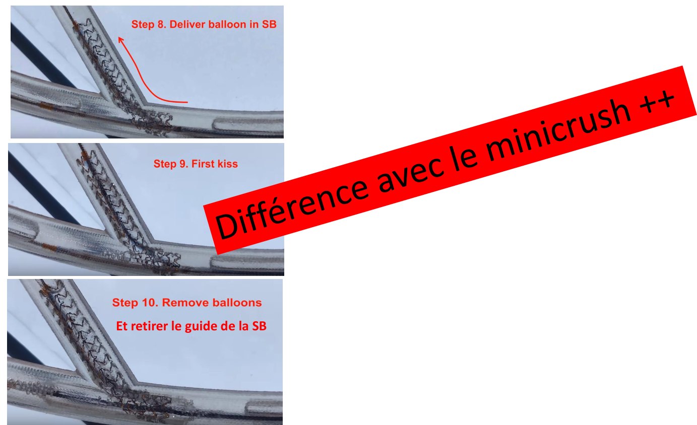 Trois vues successives du même modèle de bifurcation, numérotées et légendées : avancée d'un ballon dans la branche fille déjà écrasée, inflation simultanée des deux ballons réalisant le premier kissing, puis retrait des ballons et du guide de la branche fille.