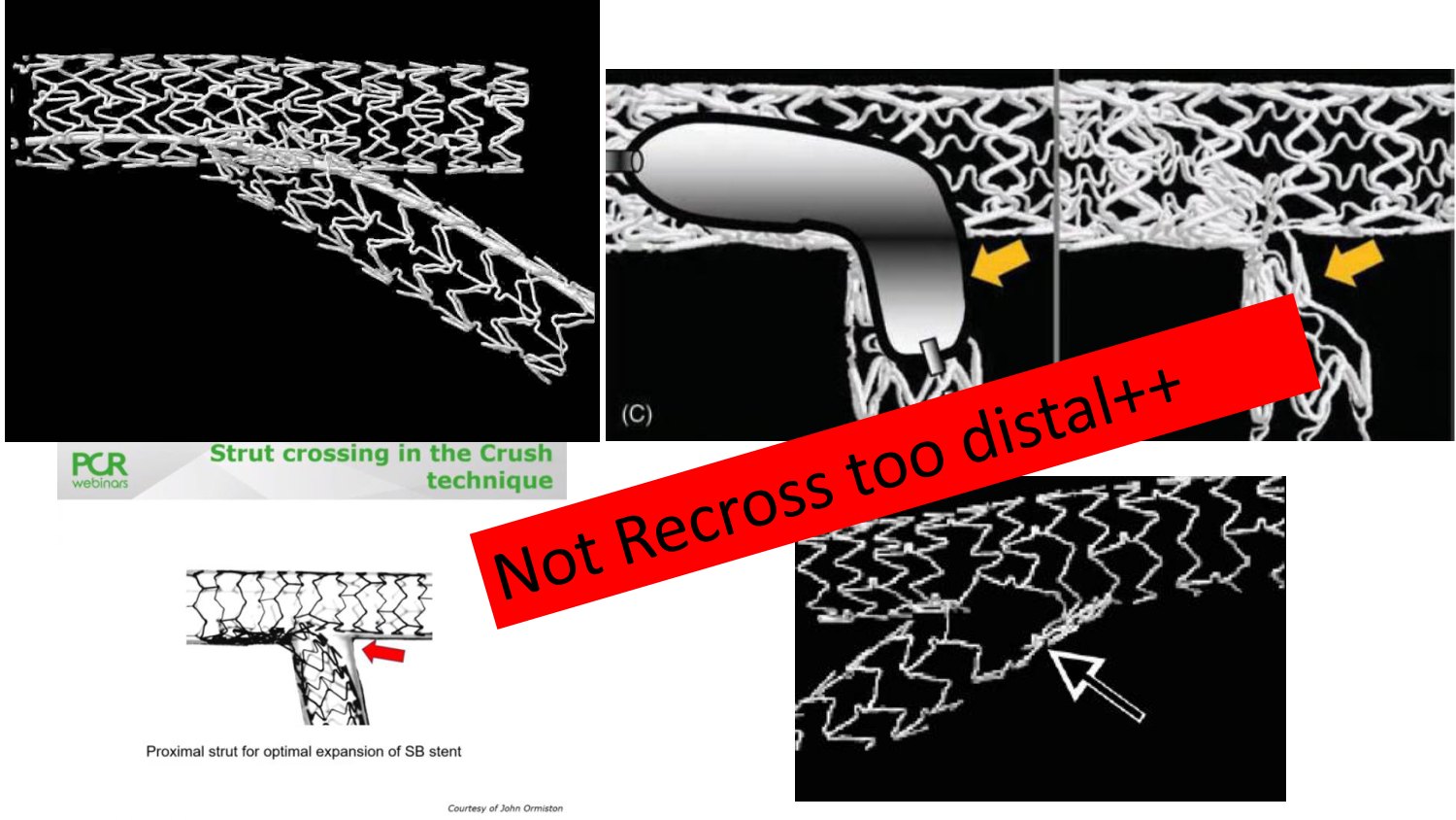 Planche associant des vues au microscope électronique d'endoprothèses écrasées et des schémas en coupe : à gauche le site d'écrasement vu de côté, au centre un ballon franchissant une maille distale avec une mention d'avertissement, à droite le repérage de la maille proximale qui permet l'expansion complète de l'endoprothèse de la branche fille.