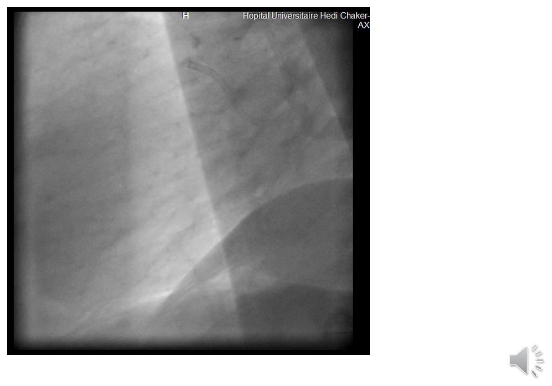 Cliché angiographique d'une artère coronaire dont l'opacification s'arrête net, sans aucun passage de produit de contraste au-delà du point d'interruption, le reste du champ ne montrant que l'ombre des structures thoraciques.