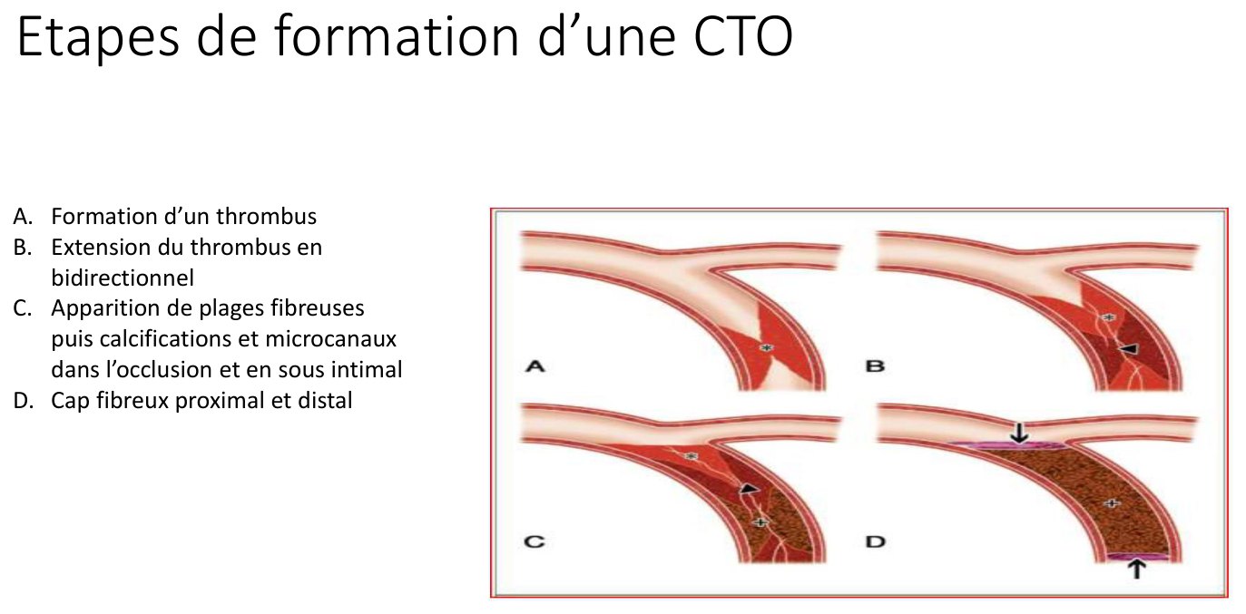 Planche en quatre vignettes légendées A à D représentant en coupe longitudinale l'évolution d'une artère coronaire depuis la formation d'un thrombus jusqu'à la constitution d'une occlusion organisée fermée à ses deux extrémités par un capuchon fibreux.