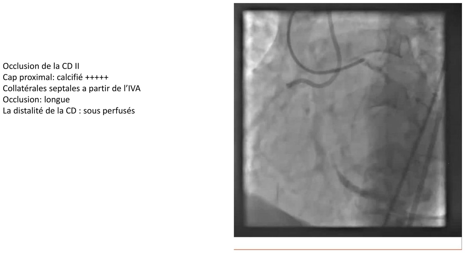 Cliché angiographique d'une occlusion du deuxième segment de la coronaire droite, accompagné d'un encadré qui en donne la lecture selon les quatre éléments. Le capuchon proximal y est noté comme très calcifié, les collatérales comme septales provenant de l'artère interventriculaire antérieure, l'occlusion comme longue, et la distalité de la coronaire droite comme sous-perfusée. L'image montre l'interruption de l'opacification et le réseau collatéral qui alimente le territoire d'aval.