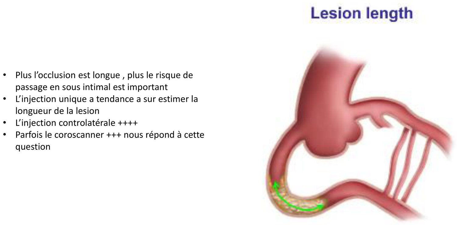 Planche de cours intitulée « Lesion length », associant quatre affirmations à un schéma d'artère coronaire. Les affirmations énoncent que plus l'occlusion est longue, plus le risque de passage en sous-intimal est important ; que l'injection unique a tendance à surestimer la longueur de la lésion ; que l'injection controlatérale est fortement recommandée ; et que le coroscanner répond parfois à cette question. Le schéma, en coupe, montre une artère dont le segment occlus est figuré par une zone d'aspect différent du reste du vaisseau.