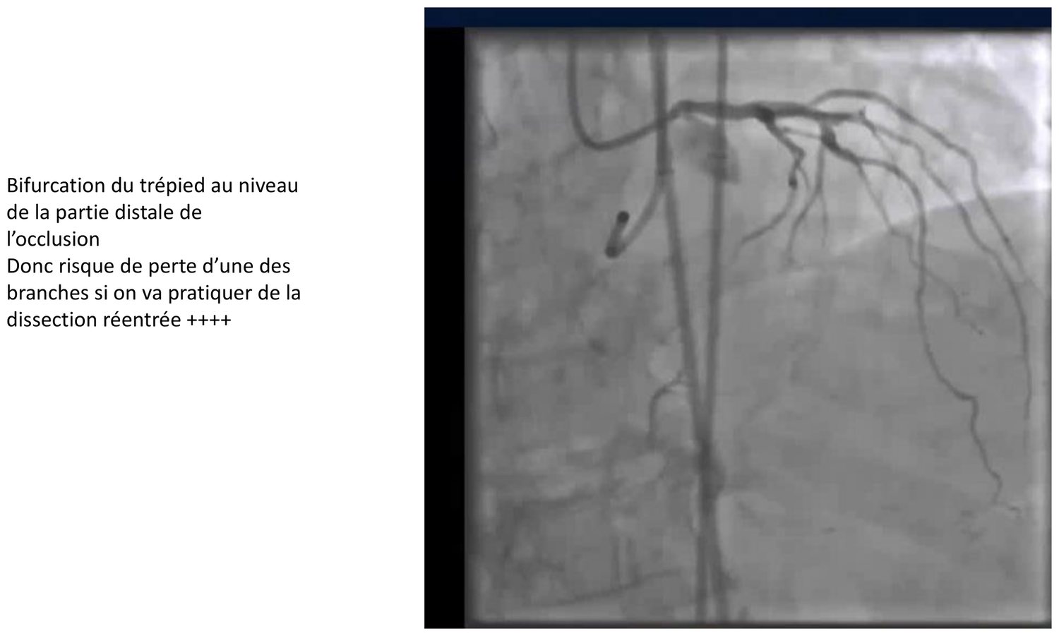Cliché angiographique accompagné d'un encadré explicatif. L'image montre une occlusion dont la reprise distale se situe au niveau de la bifurcation du trépied. L'encadré signale que cette configuration expose à la perte de l'une des branches si l'on pratique une dissection-rentrée, la branche naissant entre le point de sortie et le point de rentrée du plan sous-intimal se trouvant exclue du circuit.