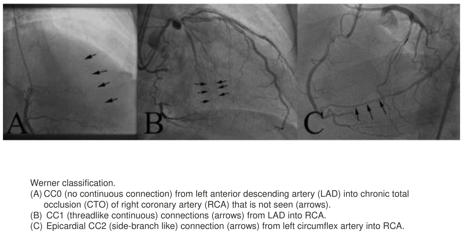 Trois clichés angiographiques placés côte à côte et repérés par les lettres A, B et C, chacun accompagné de flèches désignant les collatérales. Le cliché A illustre un grade CC0, sans connexion continue entre l'artère interventriculaire antérieure et l'occlusion de la coronaire droite, la connexion n'étant pas visible. Le cliché B illustre un grade CC1, connexion continue filiforme depuis l'interventriculaire antérieure vers la coronaire droite. Le cliché C illustre un grade CC2 épicardique, mimant une branche collatérale, depuis l'artère circonflexe vers la coronaire droite. La légende, en anglais, reprend ces trois définitions.