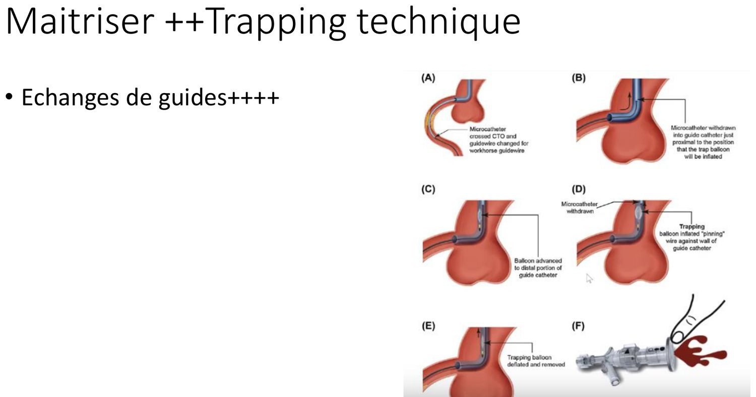 Six vignettes légendées de A à F illustrant la technique de piégeage. En A, le microcathéter a franchi l'occlusion et le guide a été remplacé par un guide de travail. En B, le microcathéter est retiré dans le cathéter guide, juste en amont de la position où le ballon de piégeage sera gonflé. En C, un ballon est avancé jusqu'à la portion distale du cathéter guide. En D, le microcathéter est retiré et le ballon de piégeage est gonflé, plaquant le guide contre la paroi du cathéter. En E, le ballon est dégonflé et retiré. La vignette F montre la manipulation à la valve hémostatique.