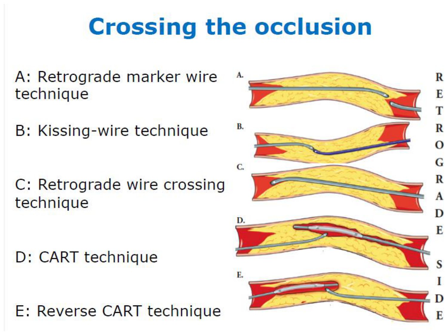 Cinq schémas superposés d'un segment artériel occlus, légendés de A à E, avec la mention « côté rétrograde » portée verticalement à droite. En A, le guide rétrograde s'arrête au capuchon distal et sert de repère au guide antérograde. En B, les deux guides progressent l'un vers l'autre dans la lumière jusqu'à se rejoindre. En C, le guide rétrograde traverse toute l'occlusion. En D, un ballon gonflé par voie rétrograde crée l'espace où entrera le guide antérograde. En E, un ballon gonflé par voie antérograde crée l'espace où entrera le guide rétrograde.