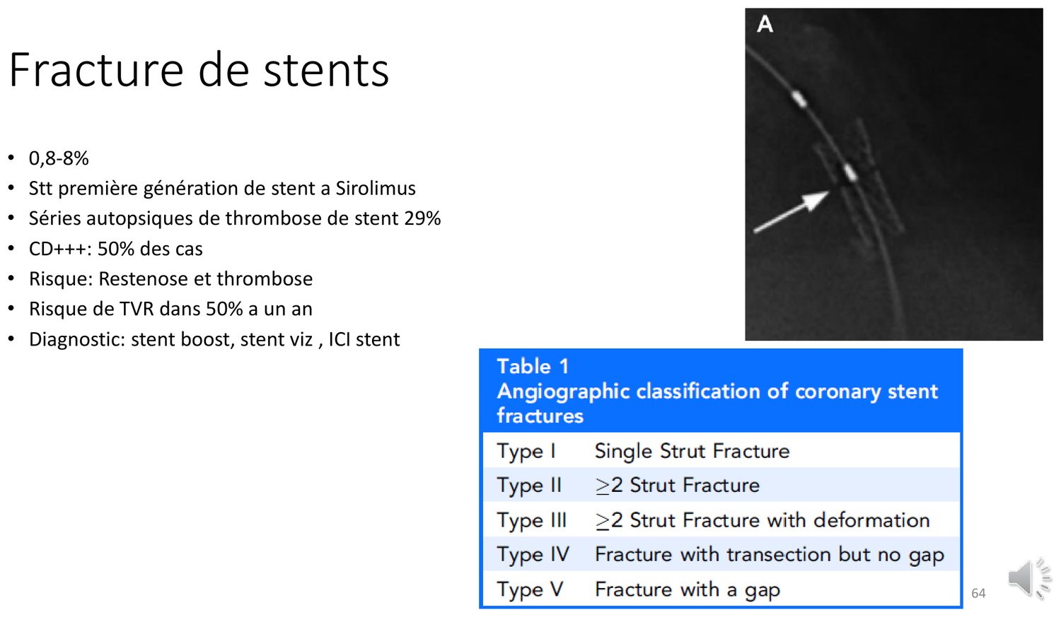 Planche associant des données chiffrées et un tableau de classification. Les données indiquent une fréquence de 0,8 à 8 %, une prédominance sur les endoprothèses au sirolimus de première génération, une fracture retrouvée dans 29 % des séries autopsiques de thrombose d'endoprothèse, une localisation sur la coronaire droite dans la moitié des cas, un risque de resténose et de thrombose, une revascularisation du vaisseau cible dans la moitié des cas à un an, et les moyens diagnostiques de rehaussement de visualisation. Le tableau classe les fractures en cinq types, de la fracture d'une seule entretoise à la fracture avec écartement.