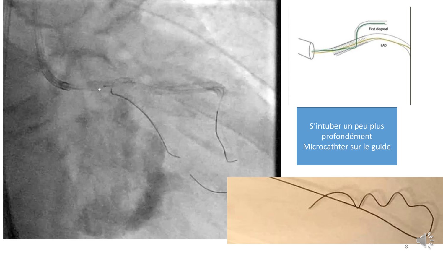 Planche montrant deux clichés angiographiques accompagnés de leurs légendes. La première manœuvre consiste à s'intuber un peu plus profondément avec le cathéter guide, afin de raccourcir la portion libre du guide et de transmettre la traction dans son axe. La seconde consiste à avancer un microcathéter sur le guide jusqu'au point de piégeage, ce qui rigidifie le guide, protège son segment le plus fragile et permet une traction bien plus contrôlée que sur le guide nu.