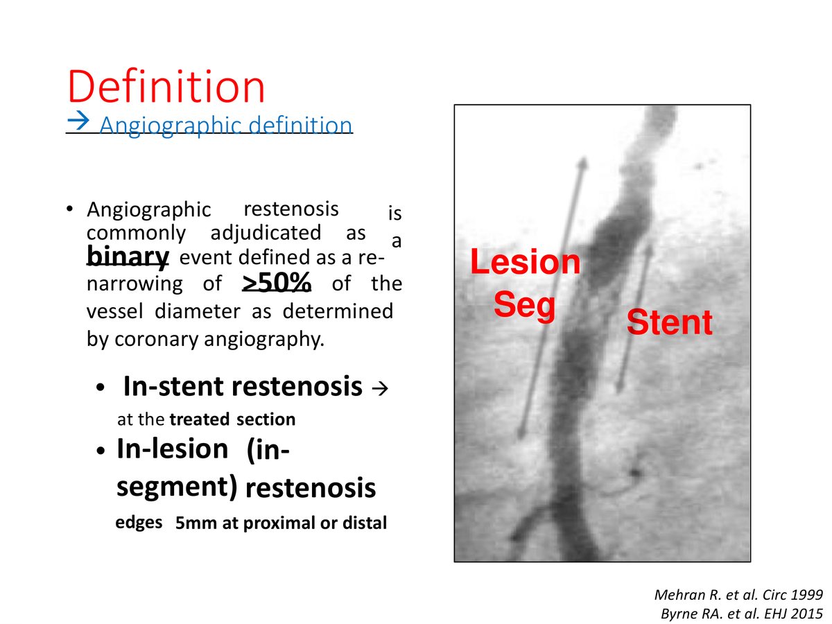Angiographie d'un segment coronaire traité par endoprothèse, avec deux repères annotés : la longueur du treillis et le segment lésionnel qui l'englobe avec cinq millimètres de marge.