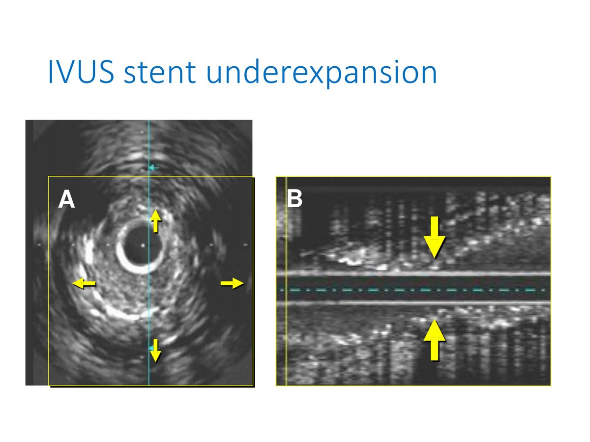 Deux vues d'échographie endocoronaire, transversale et longitudinale, montrant une endoprothèse sous-déployée dont la surface est très inférieure à celle du segment de référence.