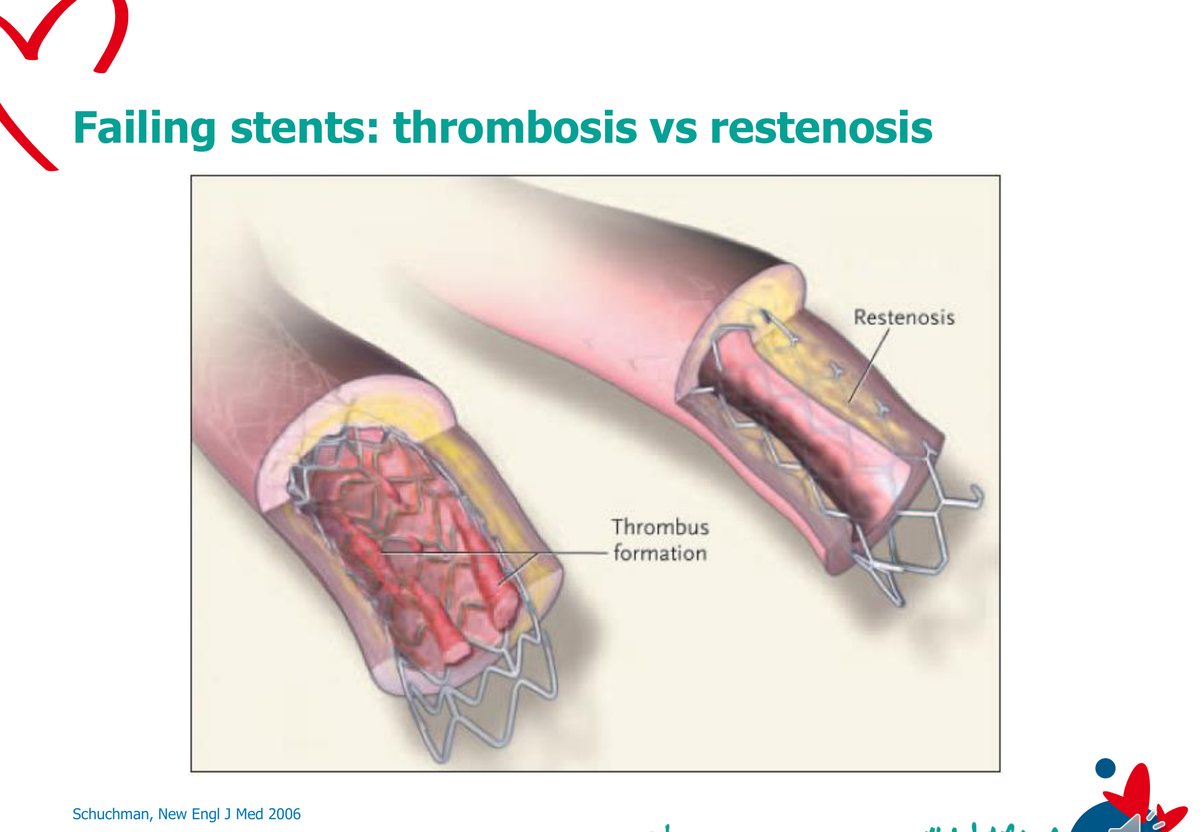 Illustration anatomique comparant deux endoprothèses en défaut : à gauche un thrombus occlusif à l'intérieur du treillis, à droite un épaississement tissulaire rétrécissant la lumière.
