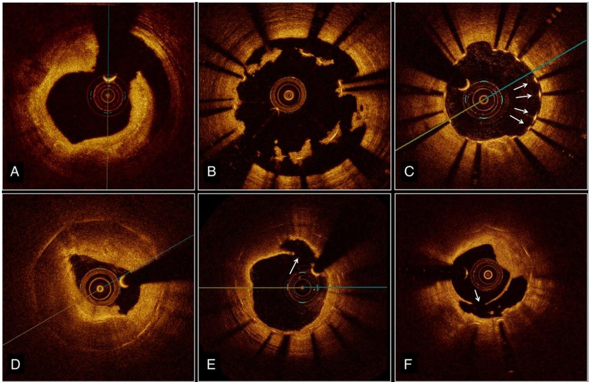 Six coupes de tomographie par cohérence optique montrant les mécanismes sous-jacents d'une thrombose d'endoprothèse : sous-expansion, malapposition, mailles non couvertes, rupture de plaque, défaut de couverture.