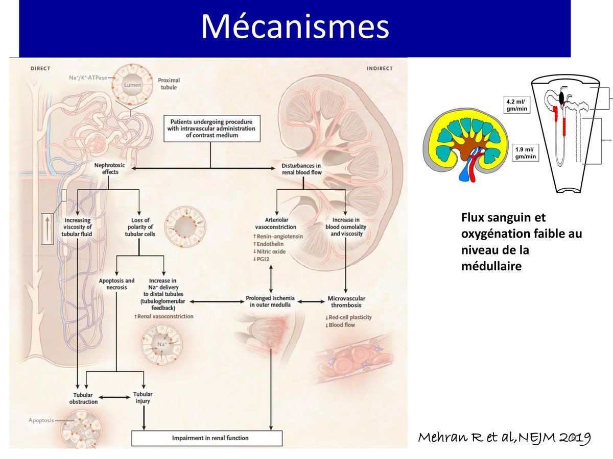 Schéma des mécanismes de la néphropathie aux produits de contraste, séparant les effets directs sur le tubule des perturbations du débit sanguin rénal, convergeant vers l'ischémie de la médullaire externe.