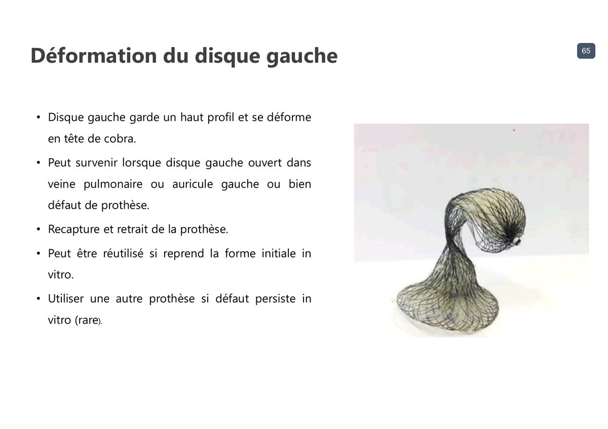 Photographie d'une prothèse septale dont le disque gauche s'est déformé en tête de cobra, gardant un profil haut au lieu de s'aplatir.