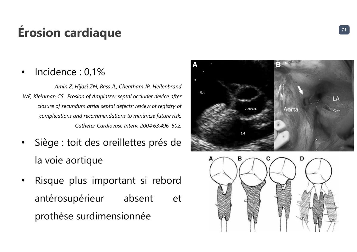 Échographie et vue opératoire d'une érosion cardiaque après fermeture septale, avec quatre schémas des configurations de contact entre la prothèse et la racine aortique.