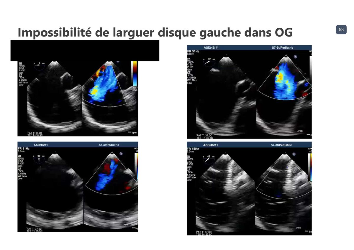Quatre échographies transœsophagiennes d'une procédure où le disque gauche ne peut être déployé dans une oreillette gauche trop petite.