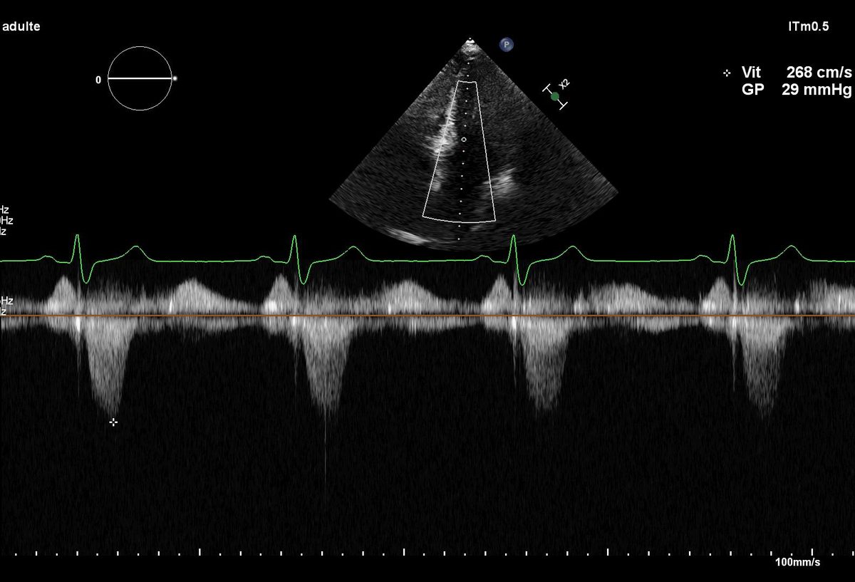 Tracé Doppler continu après alcoolisation septale, enveloppe arrondie avec une vitesse maximale de 268 cm/s et un gradient résiduel de 29 mmHg affichés par l'appareil.