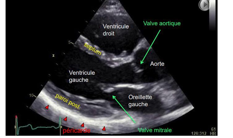Coupe parasternale grand axe légendée en français : ventricule droit, septum, ventricule gauche, paroi postérieure, péricarde, valve aortique, aorte, oreillette gauche et valve mitrale.