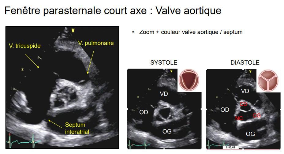 Petit axe de la valve aortique en systole et en diastole, avec les encarts schématiques des trois sigmoïdes ouvertes puis fermées.