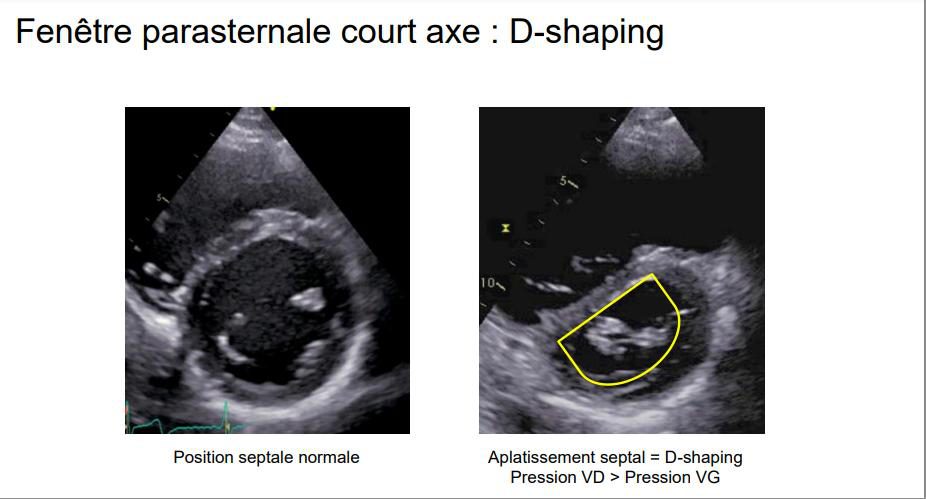 Deux petits axes du ventricule gauche : position septale normale à gauche, aplatissement septal en D à droite avec le contour tracé.