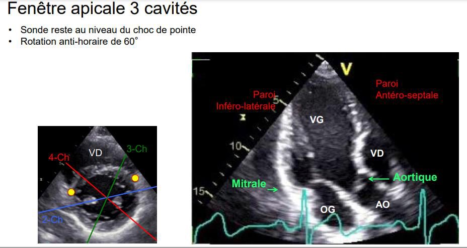 Coupe apicale trois cavités légendée en français : parois antéro-septale et inféro-latérale, ventricule gauche, oreillette gauche, aorte, valves mitrale et aortique.