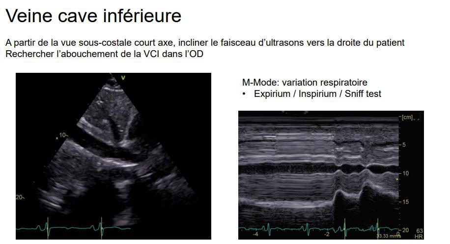 Veine cave inférieure en coupe sous-costale et son enregistrement en mode temps-mouvement montrant la variation respiratoire du diamètre.