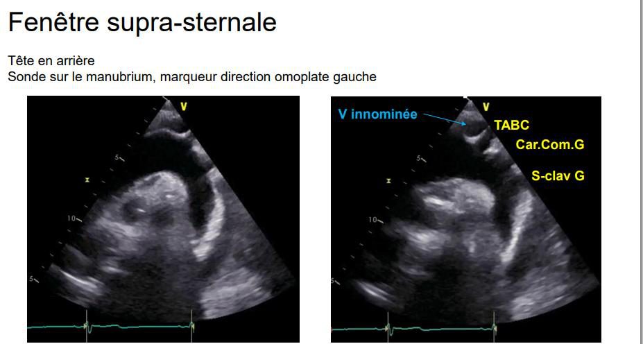 Coupe supra-sternale de la crosse aortique légendée en français : veine innominée, tronc artériel brachio-céphalique, carotide commune gauche et artère sous-clavière gauche.