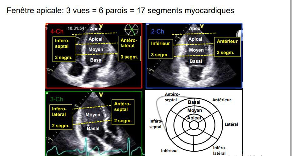 Les trois vues apicales encadrées avec leurs parois et niveaux annotés, et la cible à dix-sept segments correspondante.