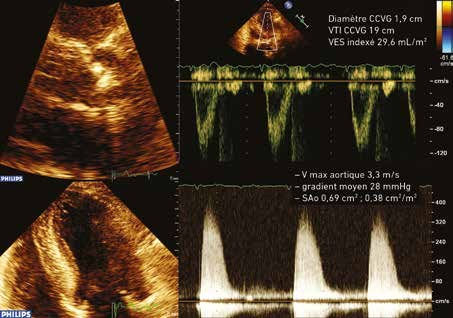 Montage échocardiographique de quatre cadrans : deux coupes apicales d'un ventricule gauche hypertrophié de petite cavité, un Doppler pulsé sous-aortique portant le diamètre de chambre de chasse à 1,9 cm et l'ITV à 19 cm, et un Doppler continu aortique dont l'enveloppe donne une vitesse maximale de 3,3 m/s.