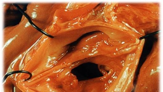Pièce anatomique montrant une perforation d'un feuillet de la valve aortique, lésion mutilante typique de l'endocardite infectieuse.