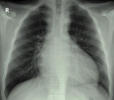 Radiographie thoracique de face réelle montrant une silhouette cardiaque élargie avec allongement de l'arc inférieur gauche, évocatrice de cardiomégalie.