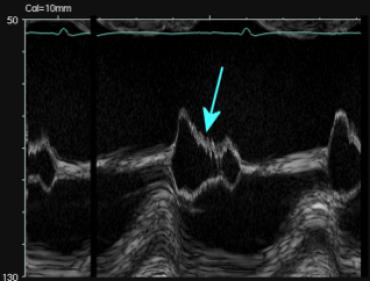 Image échocardiographique réelle en mode TM montrant, sous une flèche, le fluttering diastolique de la grande valve mitrale, signe indirect d'insuffisance aortique.