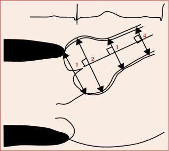 Schéma de la racine aortique avec quatre niveaux de mesure numérotés, du plus bas vers le plus haut, encadré d'un tracé ECG simplifié.