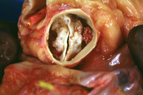 Pièce anatomique d'une valve aortique calcifiée montrant un orifice réduit à une fente étroite entre des cuspides recouvertes de nodules calcaires blanc-jaunâtres.