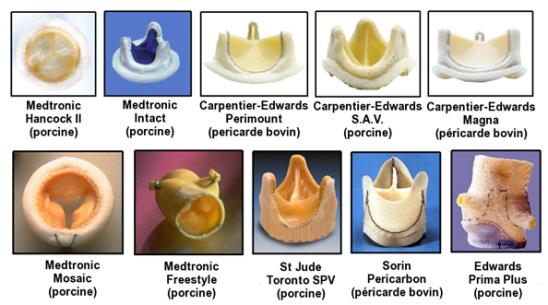 Planche de dix modèles commerciaux de bioprothèses valvulaires aortiques, en valve porcine ou en péricarde bovin, avec et sans armature.