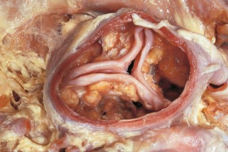 Valve aortique tricuspide avec nodules calcaires sur le corps des trois cuspides et commissures libres, caractéristique du rétrécissement dégénératif.