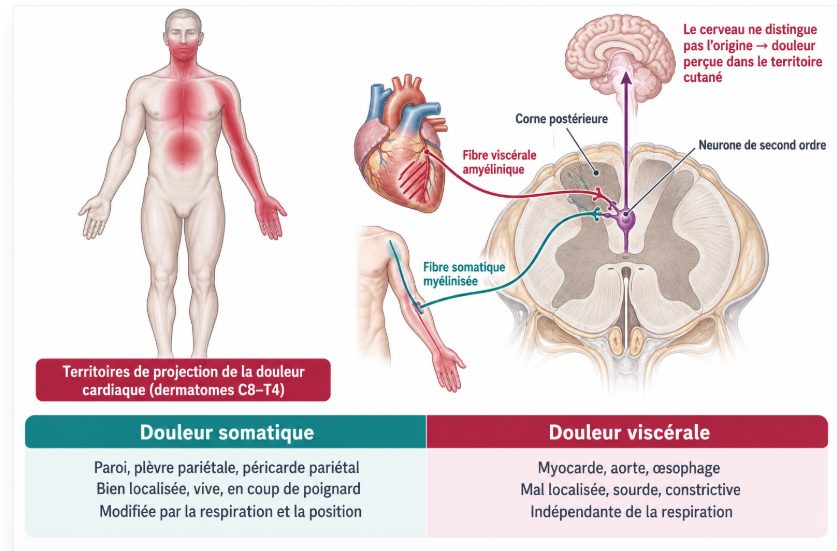 Schéma physiopathologique montrant la convergence des afférences viscérales cardiaques et des afférences somatiques cutanées sur les mêmes neurones de la corne postérieure de la moelle, expliquant la douleur projetée aux dermatomes C8-T4.