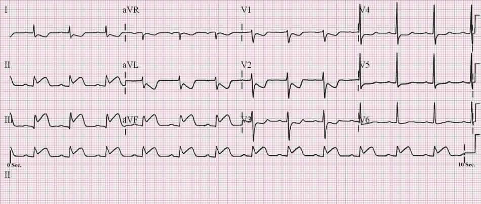 Tracé ECG douze dérivations sur papier quadrillé montrant un sus-décalage convexe du segment ST en DII, DIII et aVF avec sous-décalage en miroir en DI et aVL.