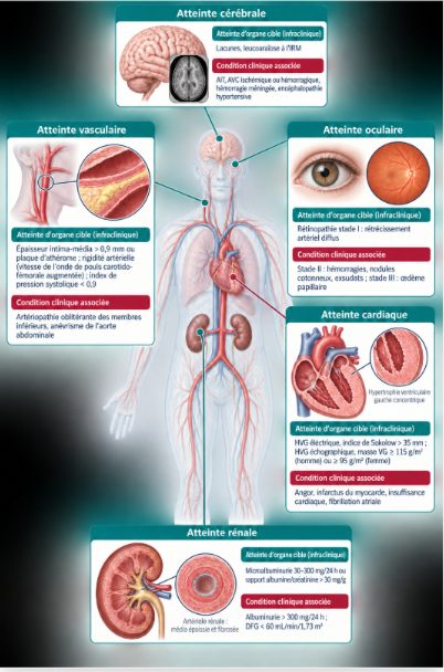 Planche anatomique synthétique montrant les cinq organes cibles de l'hypertension artérielle — cœur, vaisseaux, rein, cerveau et œil — avec pour chacun les marqueurs d'atteinte d'organe cible infraclinique et les conditions cliniques associées.